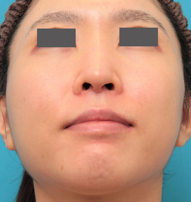 鼻の下を短く（上口唇短縮手術、上口唇リフト、リップリフト、人中短縮術）,小鼻縮小と人中短縮を同時に行った30代女性の症例写真,6ヶ月後,mainpic_biyoku053m.jpg