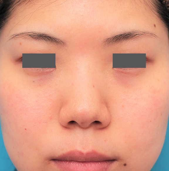 隆鼻注射（ヒアルロン酸注射）,長期持続型ヒアルロン酸を鼻筋に注射した20代女性の症例写真,Before,ba_ryubi2042_b01.jpg