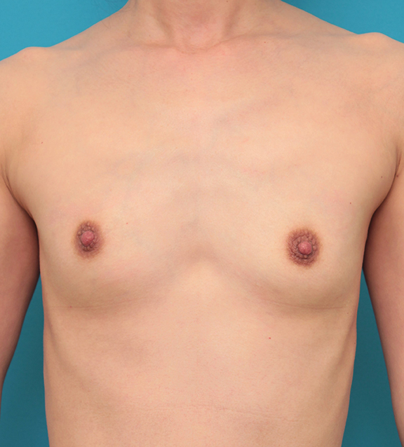 症例写真,授乳して伸びた乳首に乳頭縮小手術をした40代女性の症例写真,After（2ヶ月後）,ba_nyuto022_b01.jpg