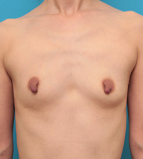 症例写真,授乳して伸びた乳首に乳頭縮小手術をした40代女性の症例写真,Before,ba_nyuto022_b01.jpg