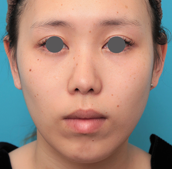症例写真,人中短縮+小鼻縮小+耳介軟骨移植を行った20代女性の症例写真,After（6ヶ月後）,ba_hanashita008_b01.jpg