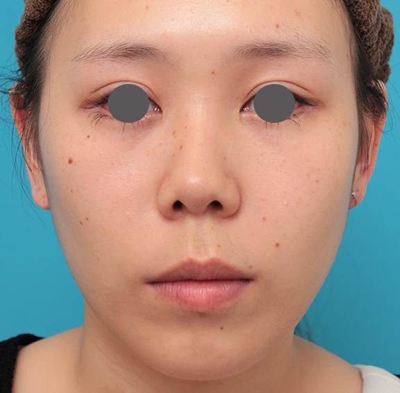 鼻の下を短く（上口唇短縮手術、上口唇リフト、リップリフト、人中短縮術）,人中短縮+小鼻縮小+耳介軟骨移植を行った20代女性の症例写真,Before,ba_hanashita008_b01.jpg