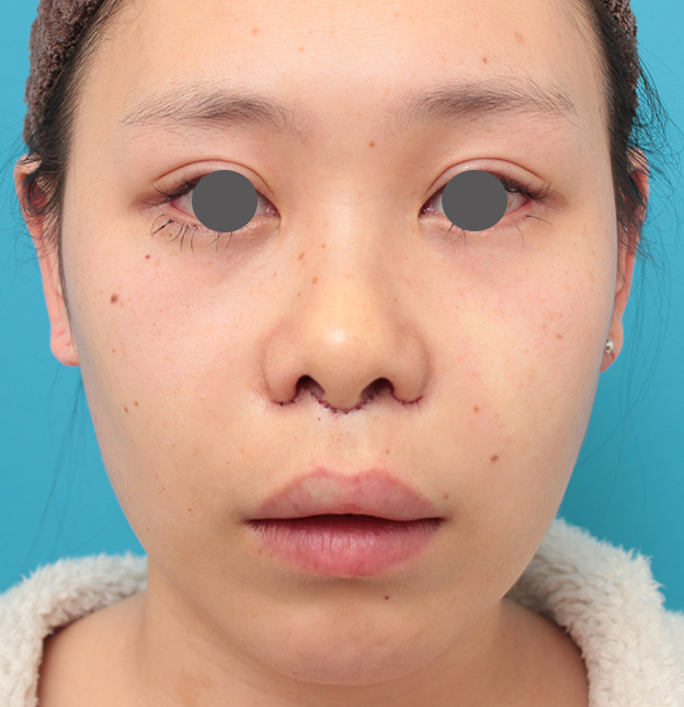 鼻の下を短く（上口唇短縮手術、上口唇リフト、リップリフト、人中短縮術）,人中短縮+小鼻縮小+耳介軟骨移植を行った20代女性の症例写真,手術直後,mainpic_hanashita008b.jpg