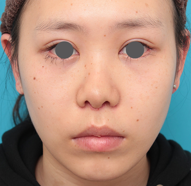 鼻の下を短く（上口唇短縮手術、上口唇リフト、リップリフト、人中短縮術）,人中短縮+小鼻縮小+耳介軟骨移植を行った20代女性の症例写真,6日後,mainpic_hanashita008c.jpg