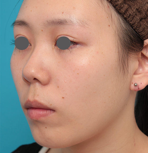 鼻翼縮小（小鼻縮小）,人中短縮+小鼻縮小+耳介軟骨移植を行った20代女性の症例写真,手術前,mainpic_hanashita008f.jpg