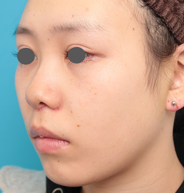 鼻の下を短く（上口唇短縮手術、上口唇リフト、リップリフト、人中短縮術）,人中短縮+小鼻縮小+耳介軟骨移植を行った20代女性の症例写真,6日後,mainpic_hanashita008h.jpg