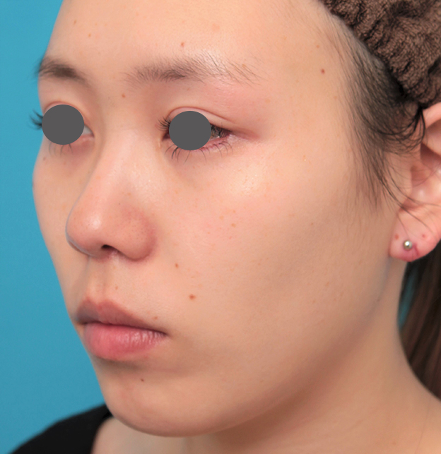 鼻の下を短く（上口唇短縮手術、上口唇リフト、リップリフト、人中短縮術）,人中短縮+小鼻縮小+耳介軟骨移植を行った20代女性の症例写真,3週間後,mainpic_hanashita008i.jpg