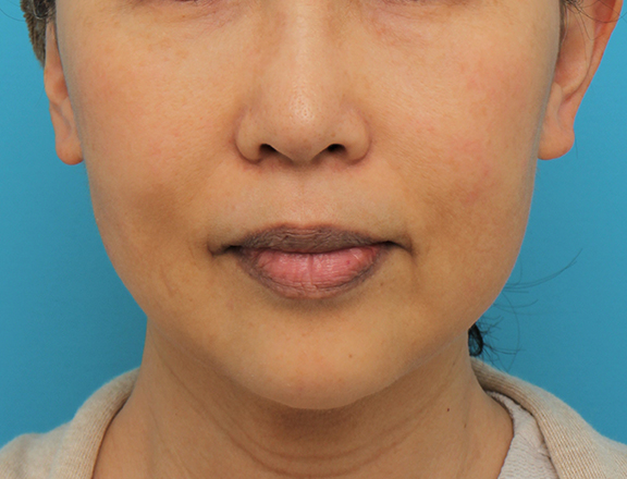 症例写真,顎にシリコンプロテーゼを入れた50代後半女性の症例写真,After（6ヶ月後）,ba_ago024_b01.jpg