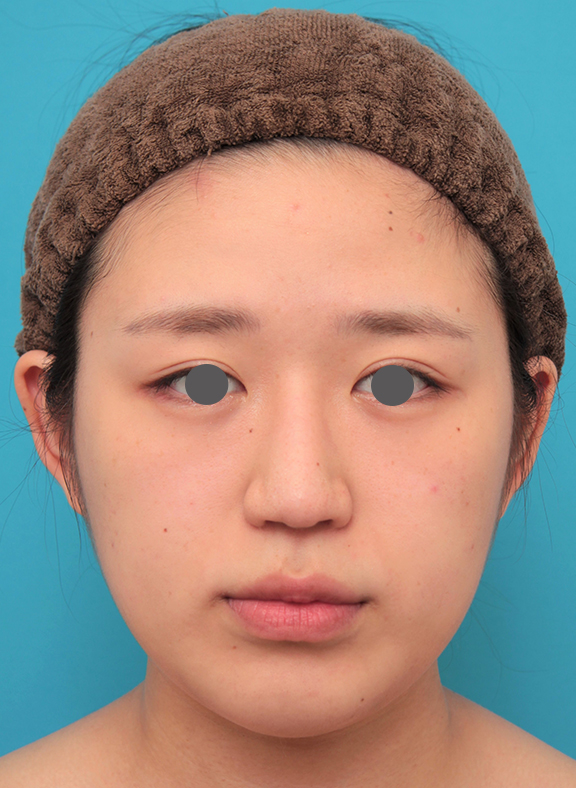 症例写真,バッカルファット除去を行った20代女性の症例写真,After（6ヶ月後）,ba_buccalfat022_b01.jpg