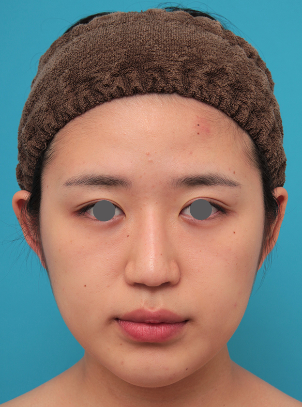 症例写真,バッカルファット除去を行った20代女性の症例写真,1ヶ月後,mainpic_buccalfat022d.jpg