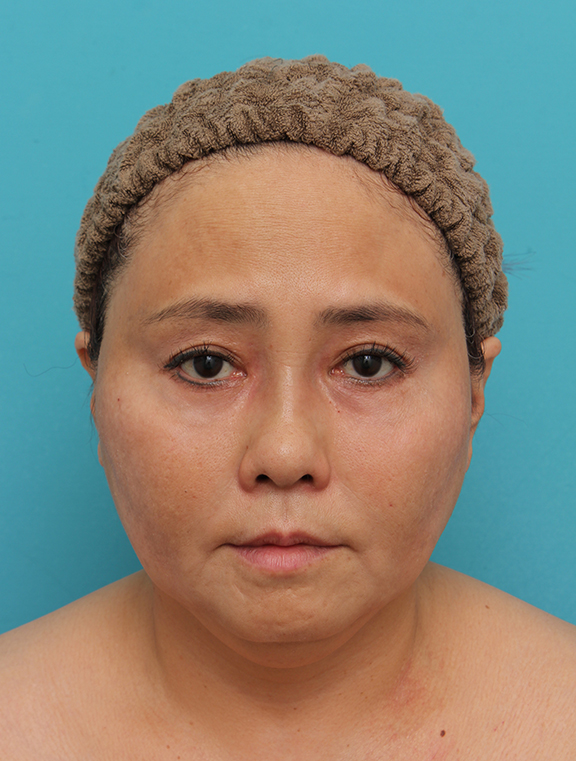 二重あご改善,1Day Yes!小顔術の施術をした50代女性の症例写真,Before,ba_1day_kogao_b01.jpg