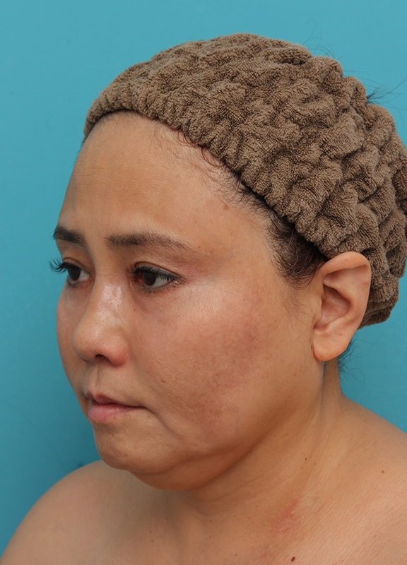 二重あご改善,1Day Yes!小顔術の施術をした50代女性の症例写真,Before,ba_1day_kogao_b02.jpg