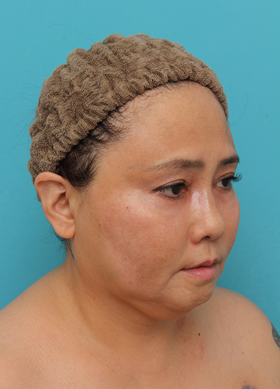 二重あご改善,1Day Yes!小顔術の施術をした50代女性の症例写真,Before,ba_1day_kogao_b04.jpg