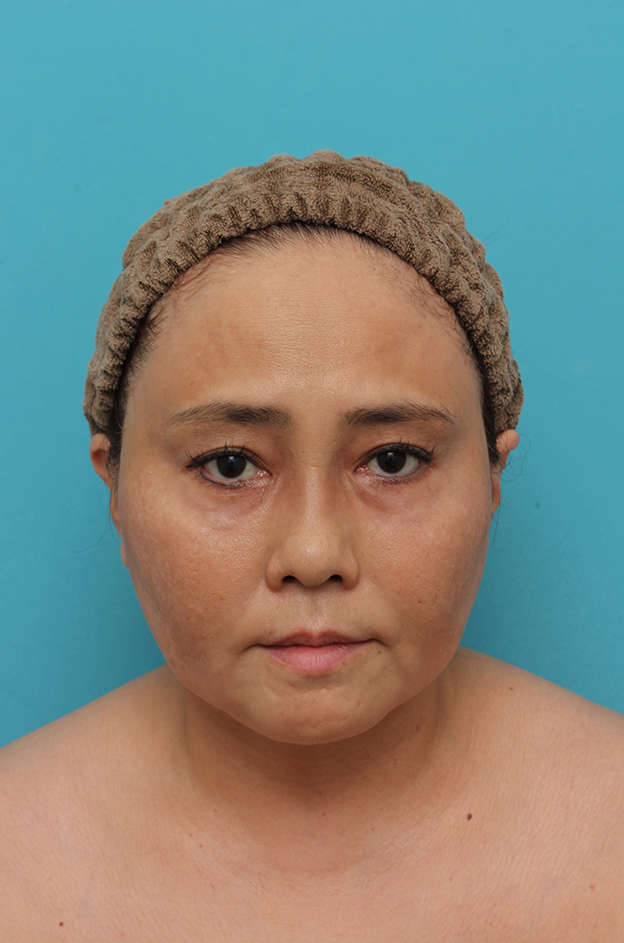 二重あご改善,1Day Yes!小顔術の施術をした50代女性の症例写真,1ヶ月後,mainpic_1day_kogao001b.jpg
