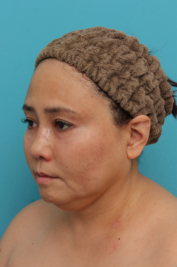 二重あご改善,1Day Yes!小顔術の施術をした50代女性の症例写真,手術前,mainpic_1day_kogao001d.jpg