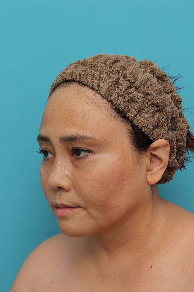 二重あご改善,1Day Yes!小顔術の施術をした50代女性の症例写真,1ヶ月後,mainpic_1day_kogao001e.jpg