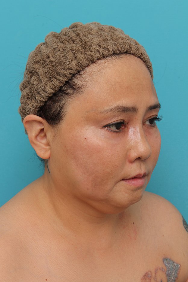 二重あご改善,1Day Yes!小顔術の施術をした50代女性の症例写真,手術前,mainpic_1day_kogao001j.jpg