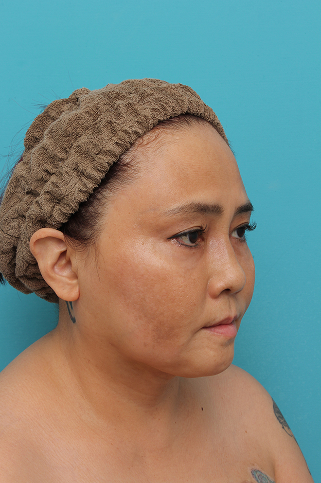 二重あご改善,1Day Yes!小顔術の施術をした50代女性の症例写真,1ヶ月後,mainpic_1day_kogao001k.jpg