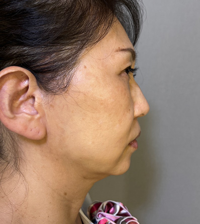1Day Yes!小顔術の施術をした40代女性の症例写真,After,ba_1day_kogao002_a01.jpg