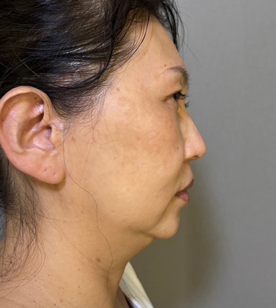 二重あご改善,1Day Yes!小顔術の施術をした40代女性の症例写真,Before,ba_1day_kogao002_b01.jpg