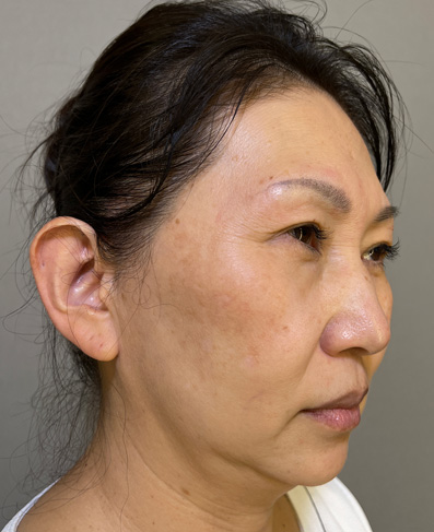 1Day Yes!小顔術,1Day Yes!小顔術の施術をした40代女性の症例写真,Before,ba_1day_kogao002_b02.jpg