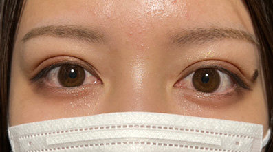 奥二重瞼をパッチリした二重瞼にした20代女性の症例,After（メイクなし）,ba_maibotsu2005_a01.jpg