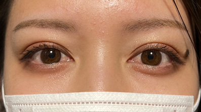 症例写真,奥二重瞼をパッチリした二重瞼にした20代女性の症例,After（メイク有り）,