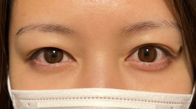 奥二重瞼をパッチリした二重瞼にした20代女性の症例,Before,ba_maibotsu2005_b01.jpg