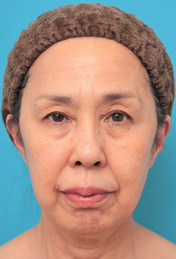 ミニフェイスリフト（頬のたるみ取り）,ミニフェイスリフトを行った60代後半女性の症例写真,After（6ヶ月後）,ba_minilift013_a01.jpg