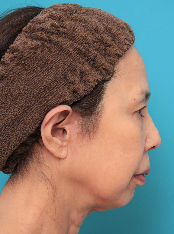ミニフェイスリフト（頬のたるみ取り）,ミニフェイスリフトを行った60代後半女性の症例写真,After（6ヶ月後）,ba_minilift013_b02.jpg