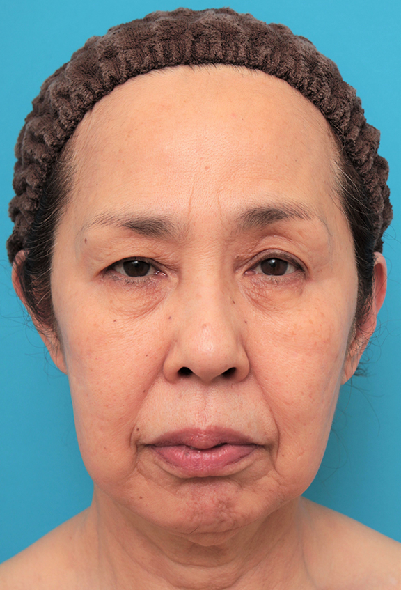 ミニフェイスリフト（頬のたるみ取り）,ミニフェイスリフトを行った60代後半女性の症例写真,Before,ba_minilift013_b01.jpg
