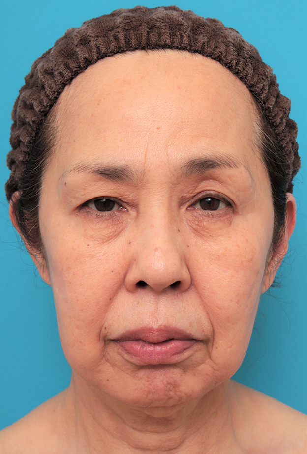 ミニフェイスリフト（頬のたるみ取り）,ミニフェイスリフトを行った60代後半女性の症例写真,手術前,mainpic_minilift013a.jpg