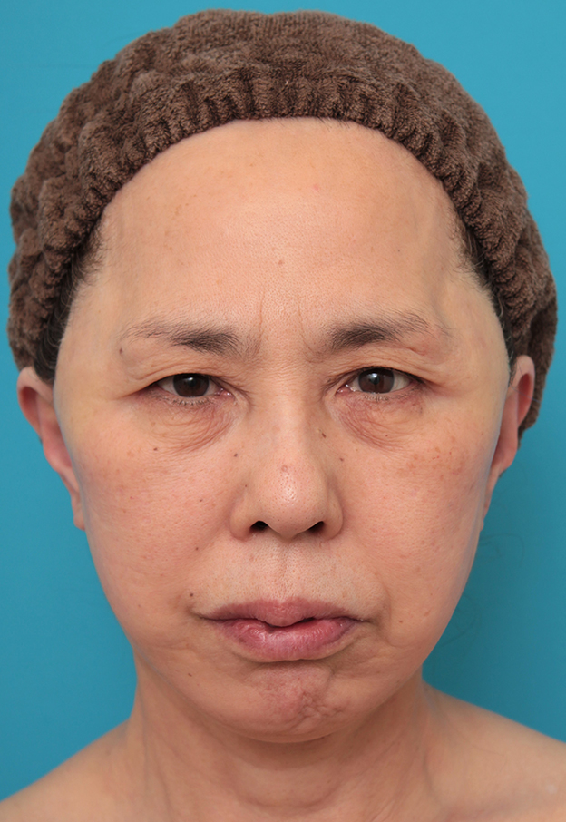 ミニフェイスリフト（頬のたるみ取り）,ミニフェイスリフトを行った60代後半女性の症例写真,手術直後,mainpic_minilift013b.jpg
