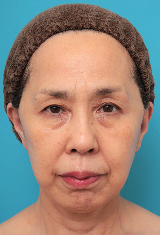 ミニフェイスリフト（頬のたるみ取り）,ミニフェイスリフトを行った60代後半女性の症例写真,6日後,mainpic_minilift013c.jpg