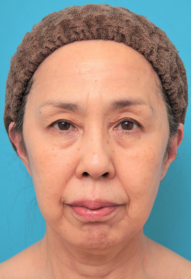 ミニフェイスリフト（頬のたるみ取り）,ミニフェイスリフトを行った60代後半女性の症例写真,6ヶ月後,mainpic_minilift013d.jpg