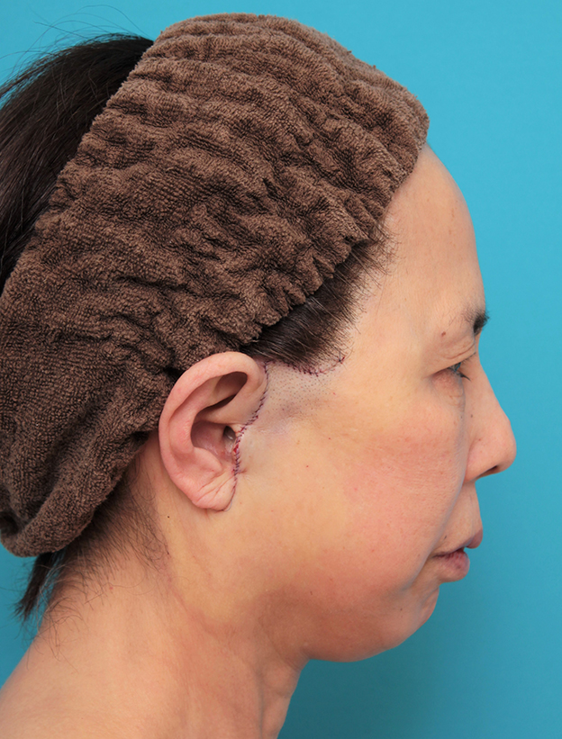 ミニフェイスリフト（頬のたるみ取り）,ミニフェイスリフトを行った60代後半女性の症例写真,手術直後,mainpic_minilift013f.jpg