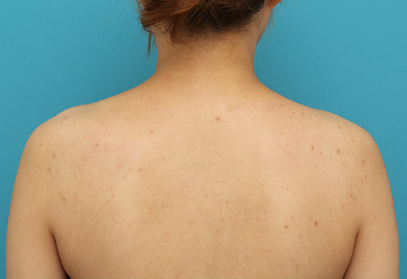 ボツリヌストキシン注射（美人肩）,肩ボトックス注射で筋肉の盛り上がりをすっきりさせた30代女性の症例写真,Before,ba_beautiful_shoulder_botox007_b02.jpg