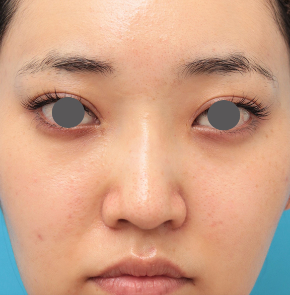 隆鼻注射（ヒアルロン酸注射）,鼻筋の長期持続型ヒアルロン酸注射+鼻先の耳介軟骨移植を行った20代女性の症例写真,After（3ヶ月後）,ba_ryubi2043_b01.jpg