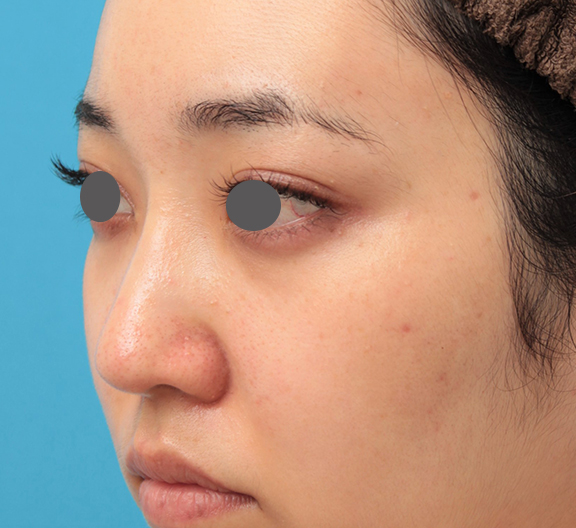 耳介軟骨移植（鼻先を出す）,鼻筋の長期持続型ヒアルロン酸注射+鼻先の耳介軟骨移植を行った20代女性の症例写真,After（3ヶ月後）,ba_ryubi2043_b02.jpg