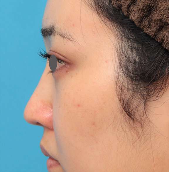 隆鼻注射（ヒアルロン酸注射）,鼻筋の長期持続型ヒアルロン酸注射+鼻先の耳介軟骨移植を行った20代女性の症例写真,After（3ヶ月後）,ba_ryubi2043_b03.jpg