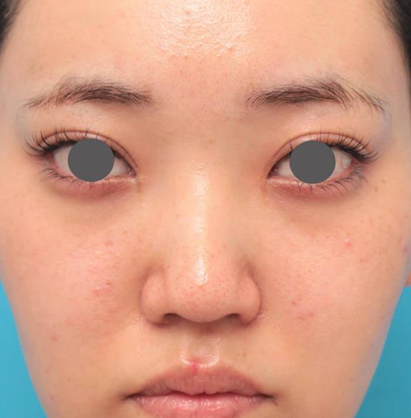 隆鼻注射（ヒアルロン酸注射）,鼻筋の長期持続型ヒアルロン酸注射+鼻先の耳介軟骨移植を行った20代女性の症例写真,Before,ba_ryubi2043_b01.jpg