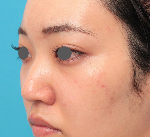 隆鼻注射（ヒアルロン酸注射）,鼻筋の長期持続型ヒアルロン酸注射+鼻先の耳介軟骨移植を行った20代女性の症例写真,Before,ba_ryubi2043_b02.jpg
