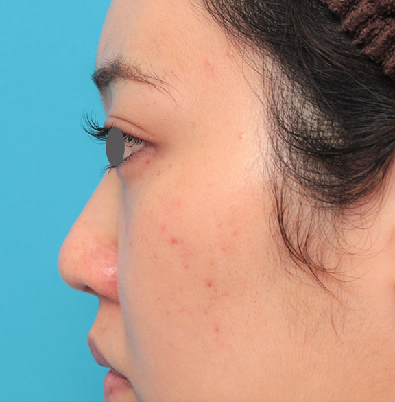 耳介軟骨移植（鼻先を出す）,鼻筋の長期持続型ヒアルロン酸注射+鼻先の耳介軟骨移植を行った20代女性の症例写真,Before,ba_ryubi2043_b03.jpg