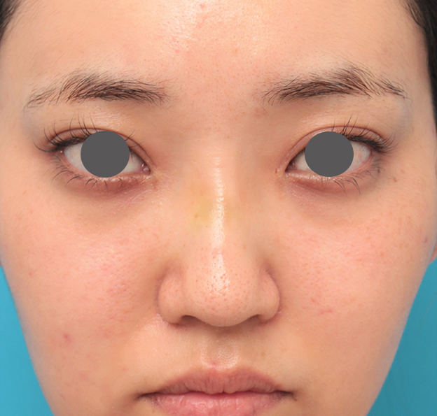 隆鼻注射（ヒアルロン酸注射）,鼻筋の長期持続型ヒアルロン酸注射+鼻先の耳介軟骨移植を行った20代女性の症例写真,6日後,mainpic_ryubi2043c.jpg