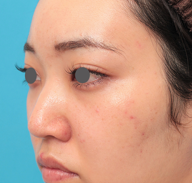 隆鼻注射（ヒアルロン酸注射）,鼻筋の長期持続型ヒアルロン酸注射+鼻先の耳介軟骨移植を行った20代女性の症例写真,手術前,mainpic_ryubi2043e.jpg