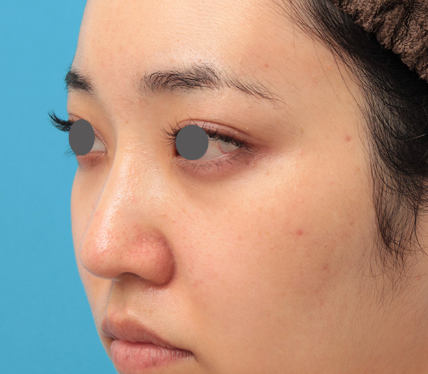 隆鼻注射（ヒアルロン酸注射）,鼻筋の長期持続型ヒアルロン酸注射+鼻先の耳介軟骨移植を行った20代女性の症例写真,3ヶ月後,mainpic_ryubi2043h.jpg