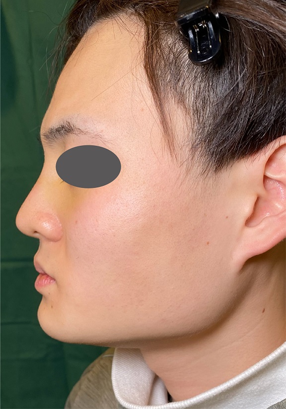 耳介軟骨移植（鼻先を出す）,耳介軟骨移植とシリコンプロテーゼによる隆鼻術を行った症例写真,After（1週間後）,ba_jikai047_b01.jpg