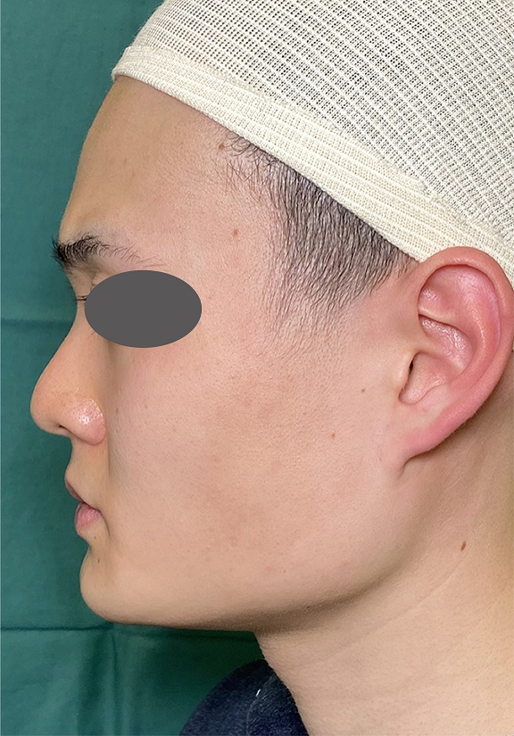 隆鼻術（シリコンプロテーゼ）,耳介軟骨移植（鼻先を出す）,耳介軟骨移植とシリコンプロテーゼによる隆鼻術を行った症例写真,Before,ba_jikai047_b01.jpg