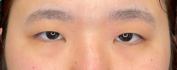 症例写真,目頭切開と二重まぶた・全切開法を行い、厚い瞼をすっきりさせた症例写真,Before,ba_megashira063_b01.jpg