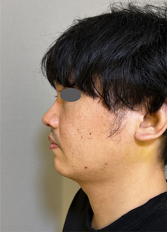 耳介軟骨移植（鼻先を出す）,耳介軟骨移植で鼻先を高くスマートに整えた症例写真,After（1週間後）,ba_jikai048_b01.jpg